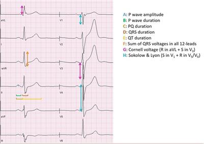 Electrocardiographic manifestations in female team handball players: analyzing ECG changes in athletes